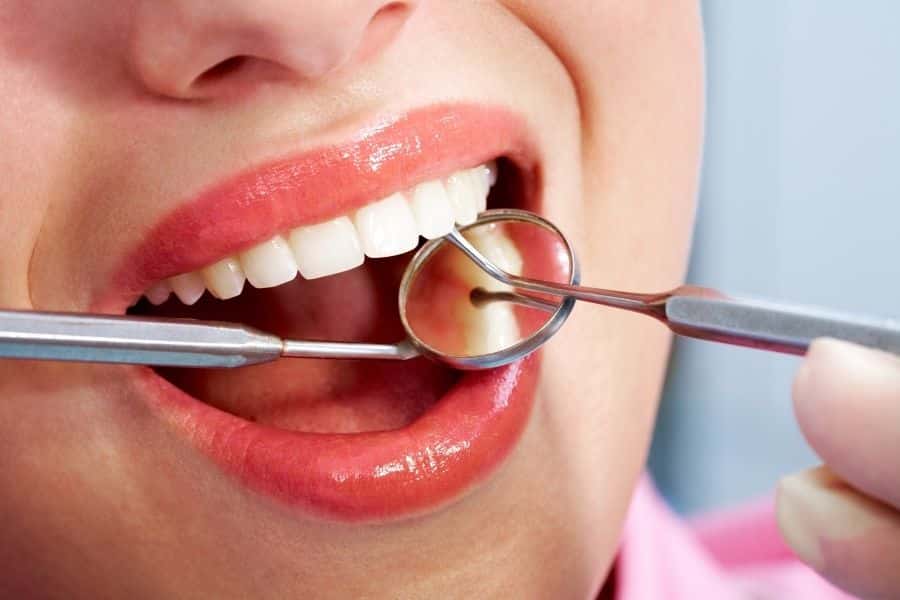 Diş Taşı Temizliği Nedir? Nasıl Yapılır?