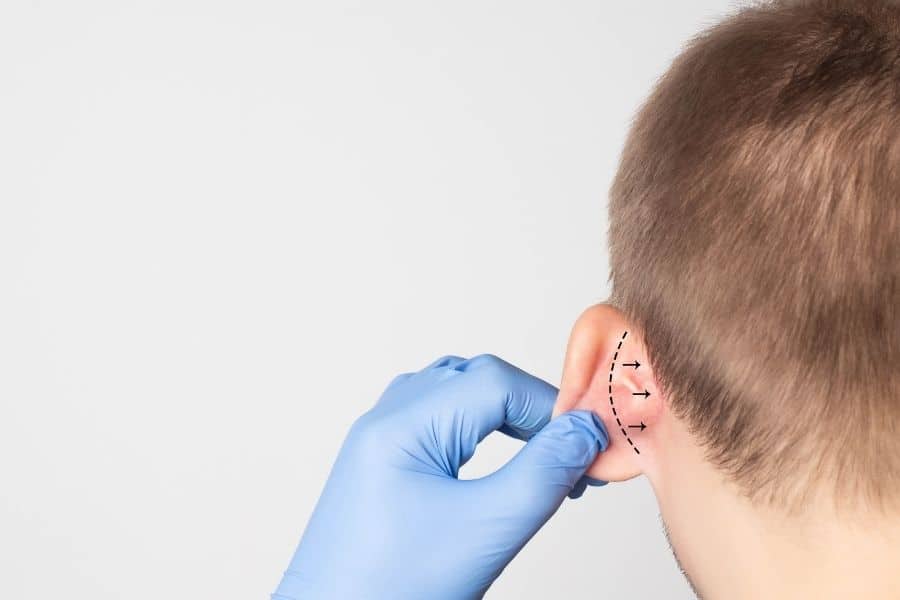 Kepçe Kulak Ameliyatı (Otoplasti) Ne Zaman Yapılır?