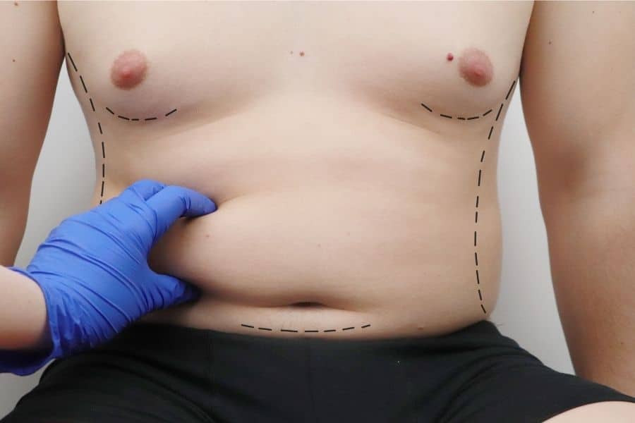 Liposuction Yağ Aldırma Ameliyat Teknikleri